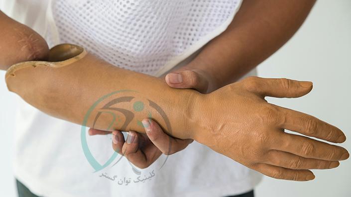 قیمت پروتز دست مصنوعی چگونه مشخص می‌شود؟