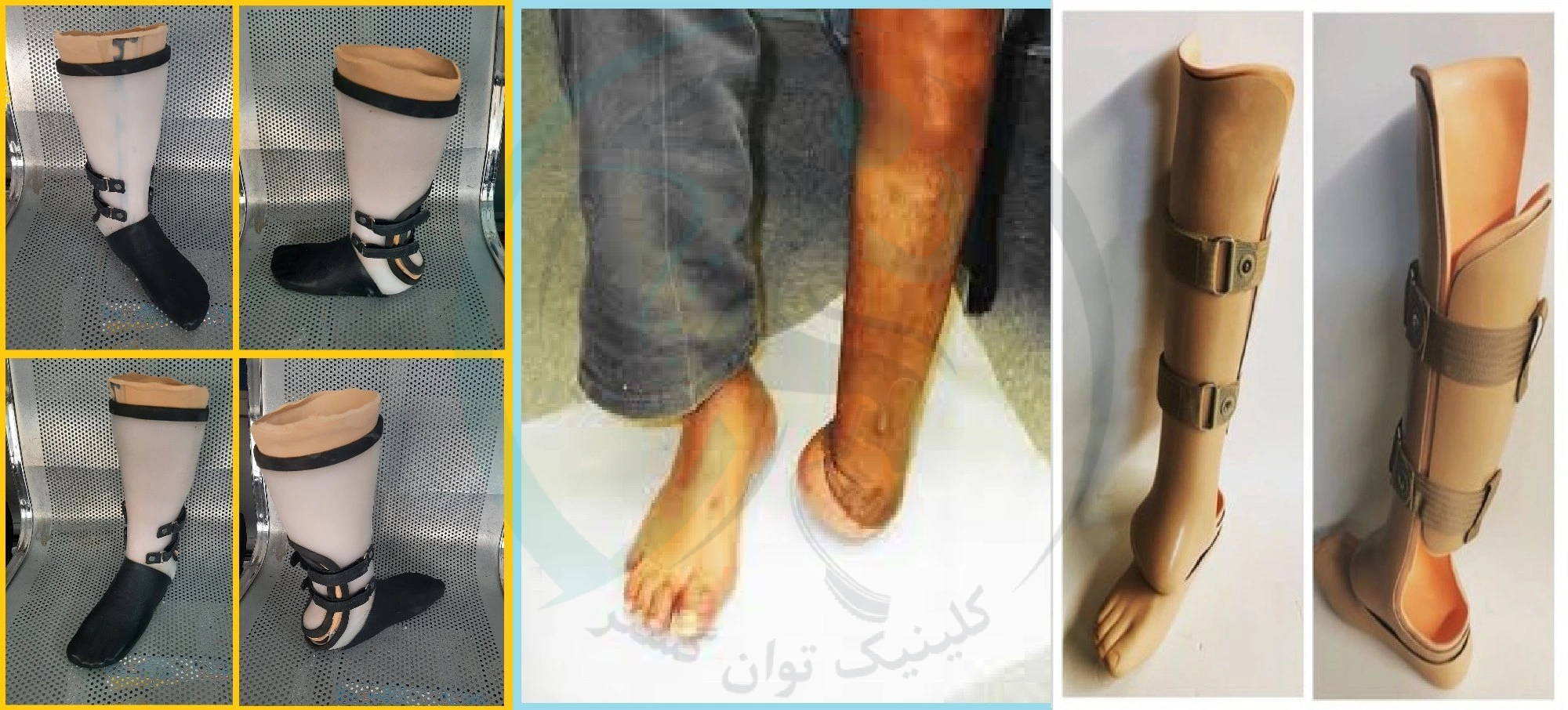 پروتز مچ پا چیست