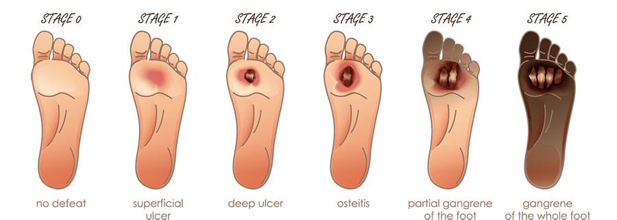 انواع زخم پای دیابتی